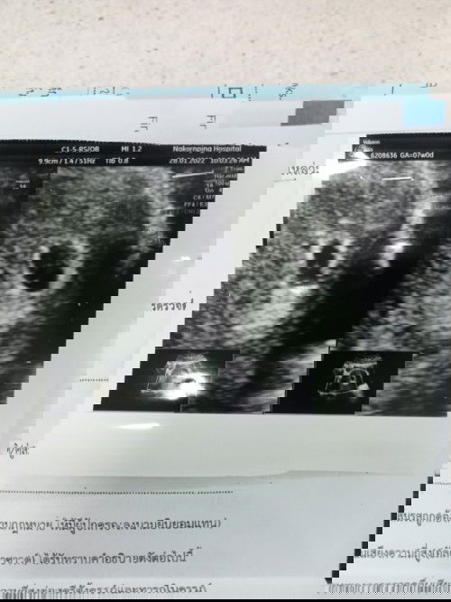 ตั้งครรภ์แรก