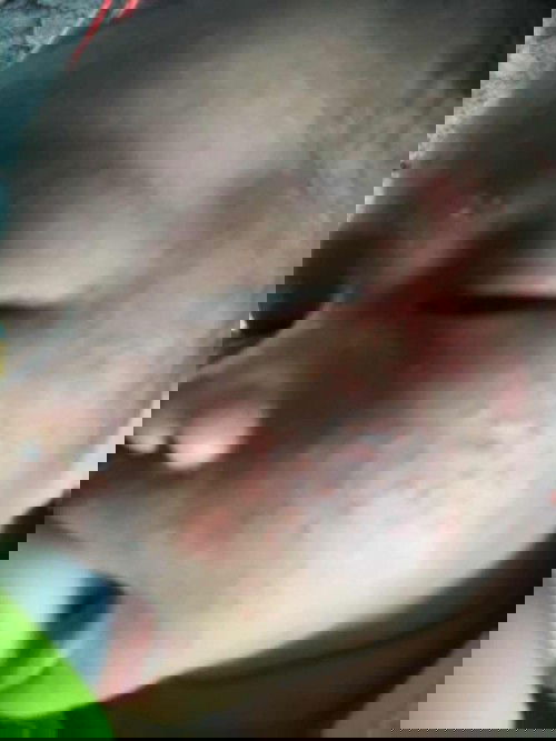 น้อง1เดือนเเล้วมีผื่นขึ้น