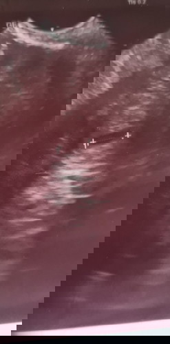 Sac tak cantik still got hope ke utk baby survive? 6w