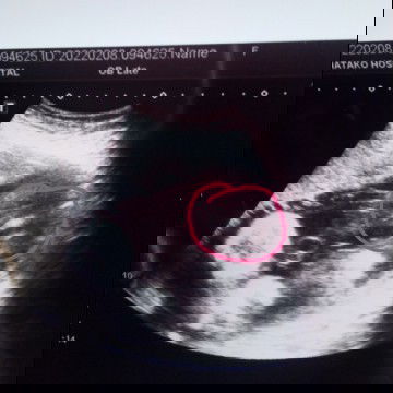 แม่ๆช่วยดูให้หน่อยค่ะว่าน้องเป็นผู้หญิงหรือผู้ชาย คุณหมอบอกผู้หญิงค่ะ แต่แม่ยังไม่ชัวเท่าไหร่