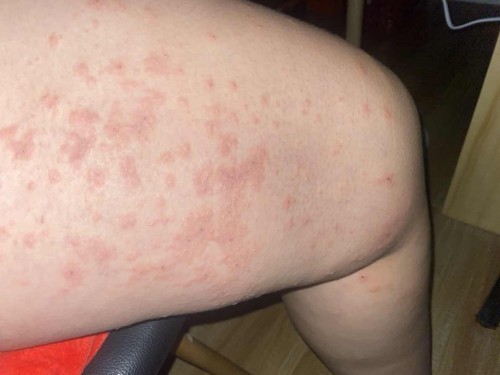 Eczema/PUPPP rashes