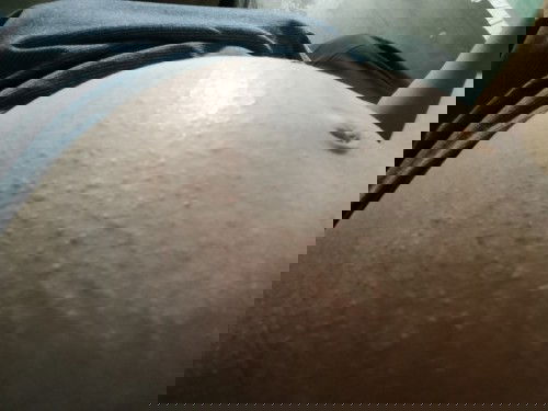 แม่ๆบ่านไหนมีผื่นแดงคันอยู่ท้องบ้างคะ31สัปดาห์แล้วค่ะคันมาก