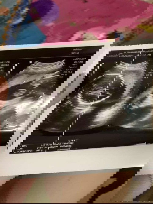 Janin nutupin kelamin