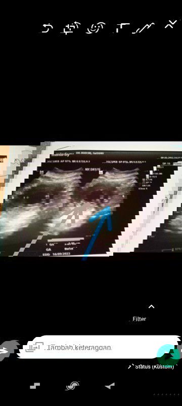 Usia kandungan 9 minggu