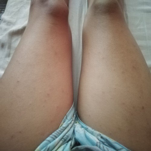 Hi po,

Pa help naman po. First time mommy here, and suddenly these rashes appeared. Sobrang kati po