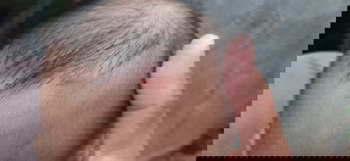 Ada semacem jerawat di babyku kira2 apa yah ? Bahaya gk yah ?