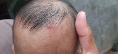 Ada semacem jerawat di babyku kira2 apa yah ? Bahaya gk yah ?