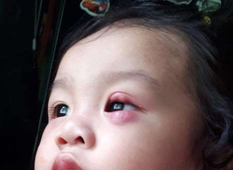 Pigsa daw sabi ng pedia pero may napansin akong dalawang tumubo pa sa taas. meron po ba similar exp?