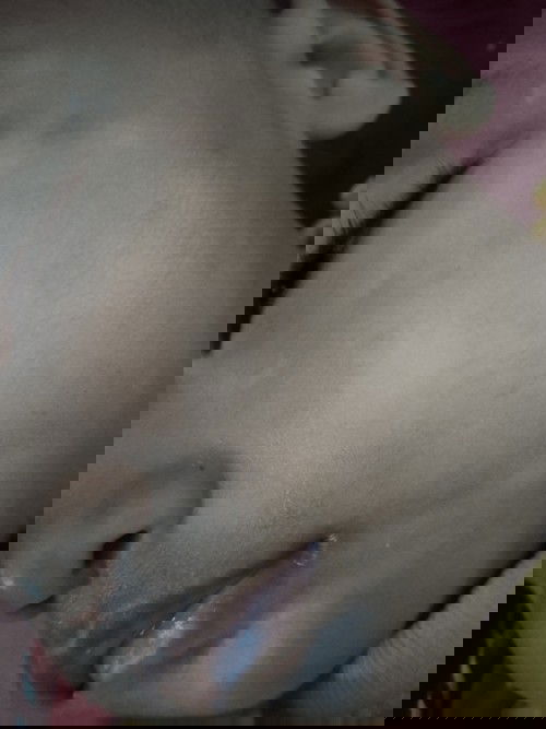 Bercak putih putih seperti panu , kering seperti mau ganti kulit