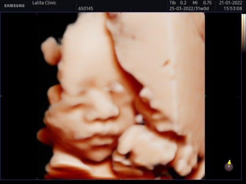 น้องลิน ทีม 23 มีนาคม 2565