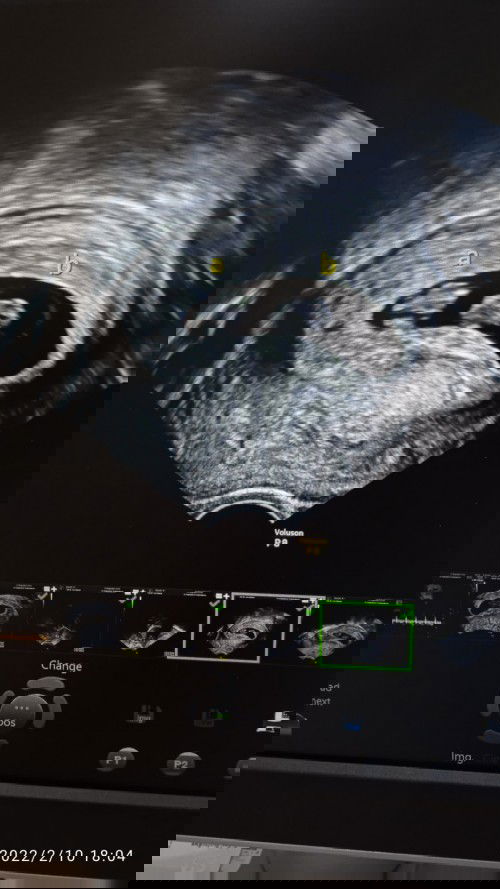 มีแม่บ้านไหนท้องแฝดบ้างคะ อัลตร้าซาวด์ผ่านหน้าท้องเจอคนเดียว พออัลตร้าซาวด์ผ่านช่องคลอดเจอสองคนเลย🤗