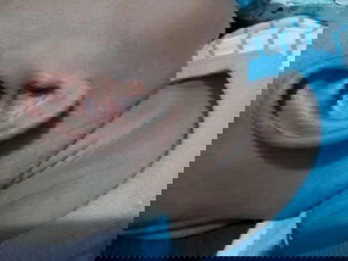 Bercak putih di leher bayi