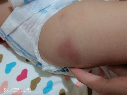 Normal bang may pasa ung gilid ng pinagbakunahan ni baby ng Immunization?