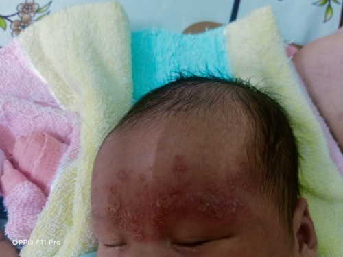 M.n cho e hỏi bé 1th nỗi như z có s k ak? cho e hỏi có thuốc j bôi k ak!