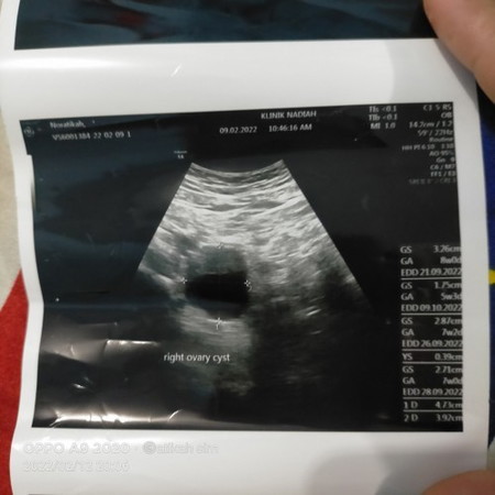 cyst masa mengandung