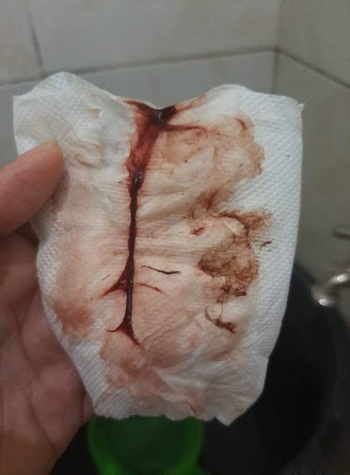 Bleeding at 6 weeks