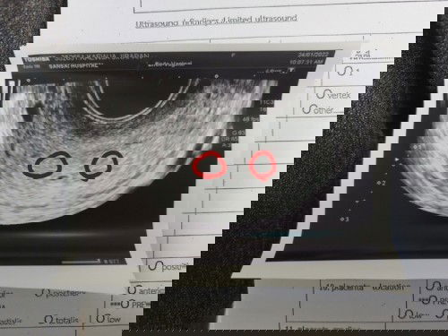 ท้องแฝดหรือถุงน้ำ?