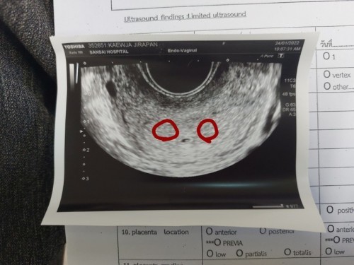 ท้องแฝดหรือถุงน้ำ?