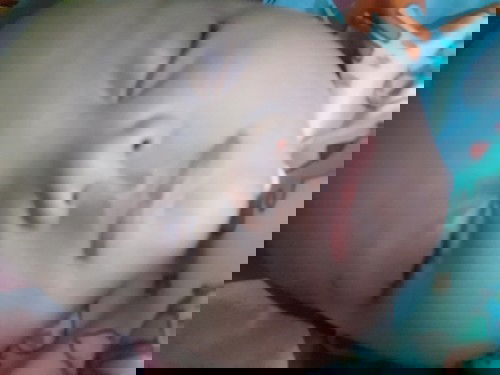 Belekan pldan bapil pada bayi usia 3 bulan