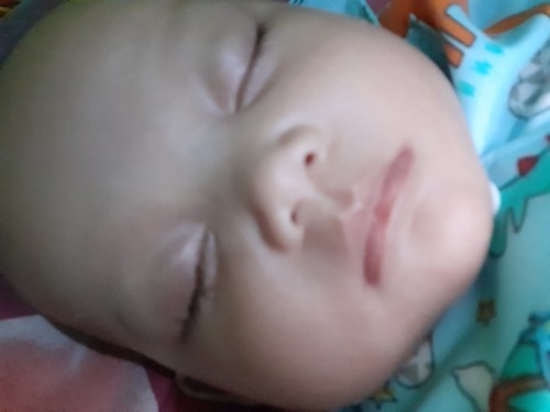 Belekan pldan bapil pada bayi usia 3 bulan