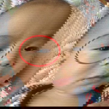 รอยขาวๆรอบตา