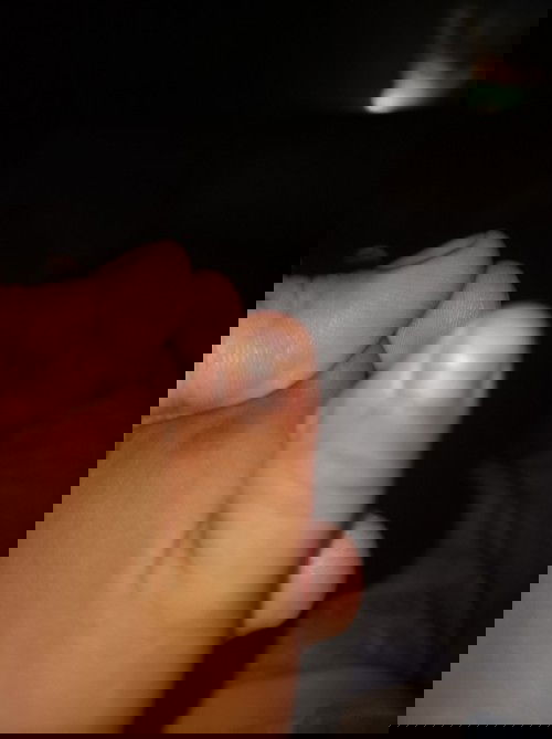 Normal lang ba matanggal amg kuko ni baby?