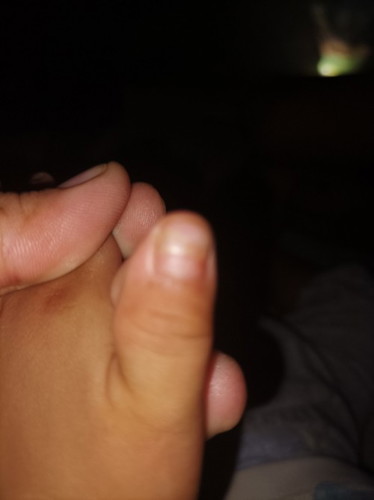 Normal lang ba matanggal amg kuko ni baby?