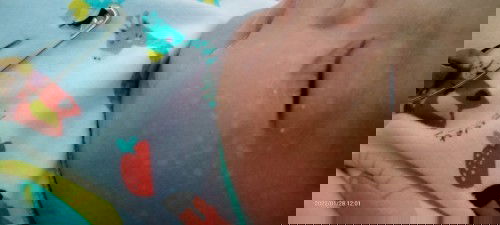 Bercak putih di pipi