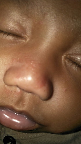 Masalah kulit baby umur 2 bulan