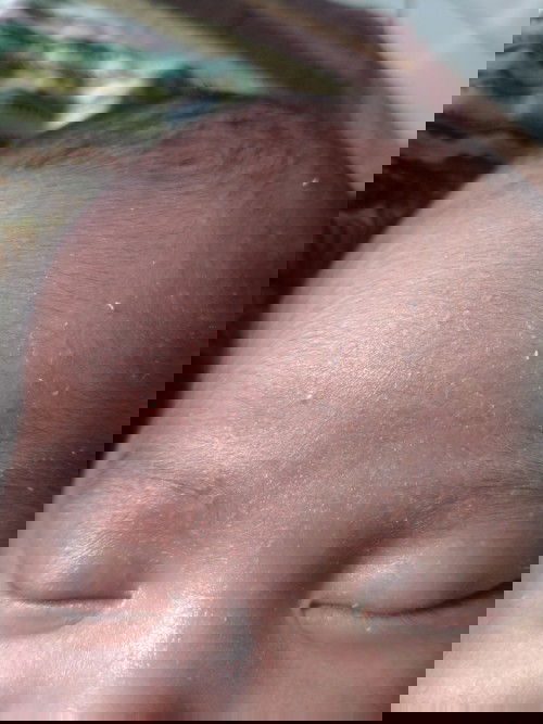 Cara menghilangkan putih putih di dahi