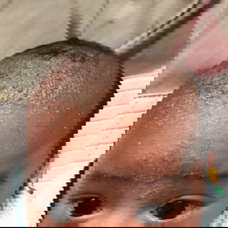 kerak di kepala dan jidat bayi