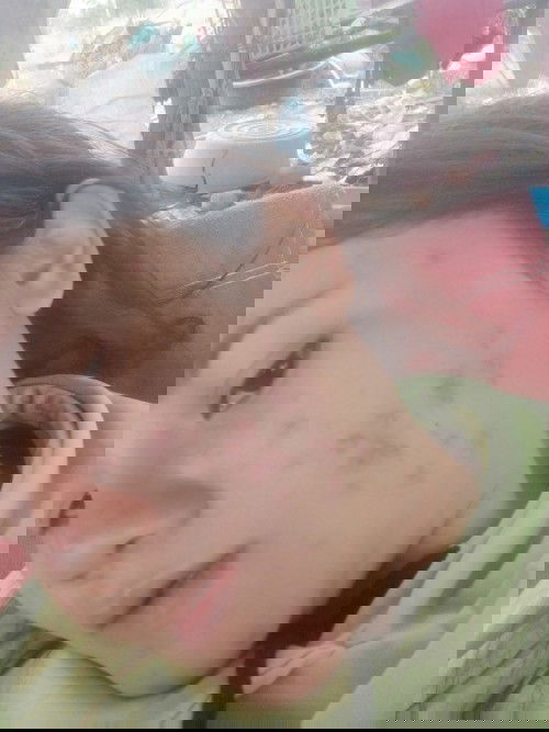 สิวบุกหนักมาก