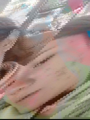 สิวบุกหนักมาก