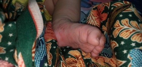 Kaki kiri gatal bintil2 berair