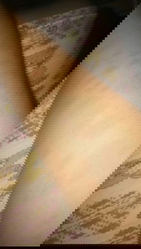 Hamil 5 bulan Bercak merah di kulit dan gatal