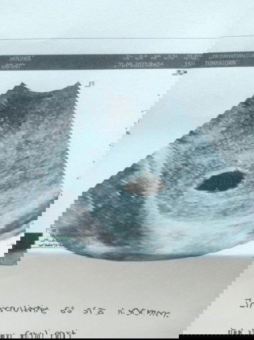 แม่พึ่งไปอัลตร้าซาวด์มา ปรากฏว่ายังไม่เจอตัวน้อง คุณหมอนัดแม่อีก2w เพื่อตรวจซ้ำ แม่ท้อง 8w