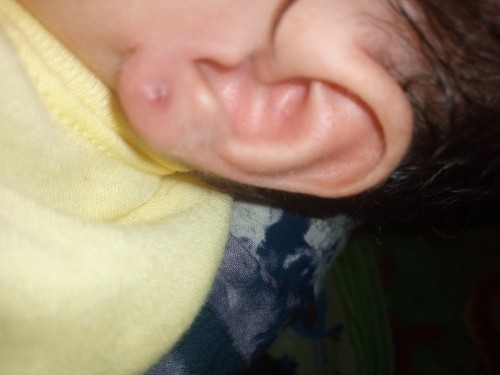 Benjolan di bekas tindik