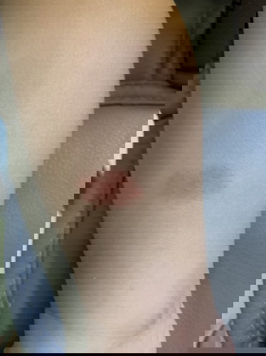 Is this insect bite?
