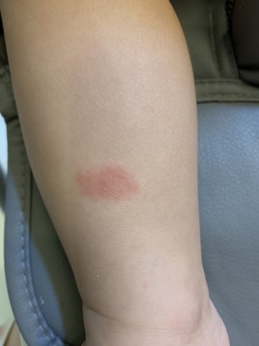 Is this insect bite?