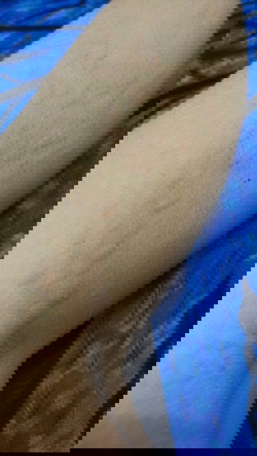 Gatal dan bentol pada TM3