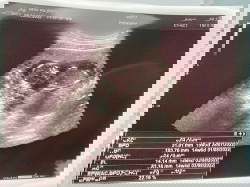 เจาะเลือดตรวจดาวน์ซินโดม