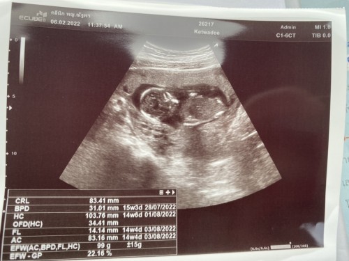 เจาะเลือดตรวจดาวน์ซินโดม