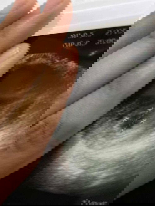 11 minggu masih belum nampak janin