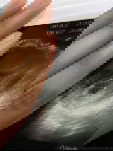 11 minggu masih belum nampak janin