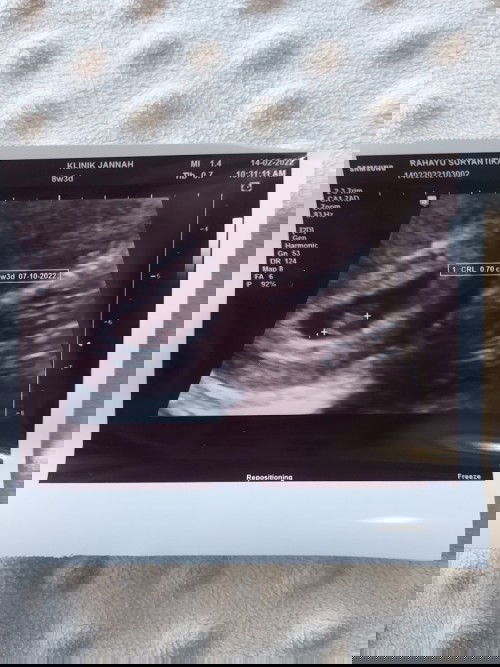 Usia kehamilan 8weeks Janin 6weeks