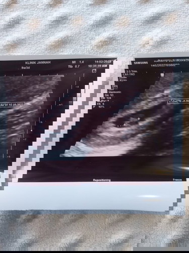 Usia kehamilan 8weeks Janin 6weeks