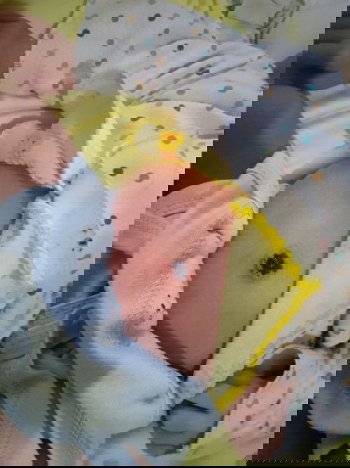 Pusar bayi berdarah setelah puput