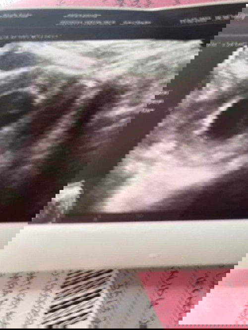 Scan 10 weeks Sesiapa ada pengalaman ??