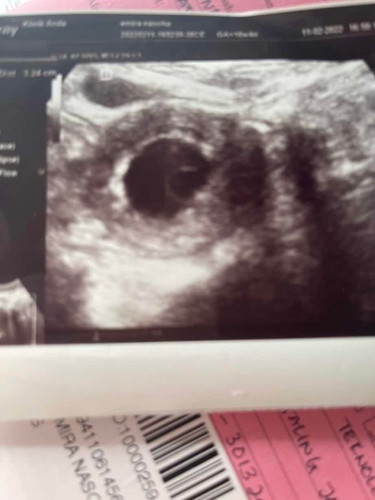 Scan 10 weeks Sesiapa ada pengalaman ??
