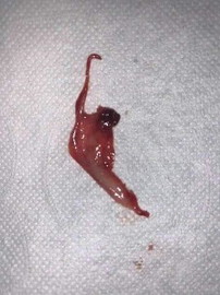 Miscarriage po ba ito?